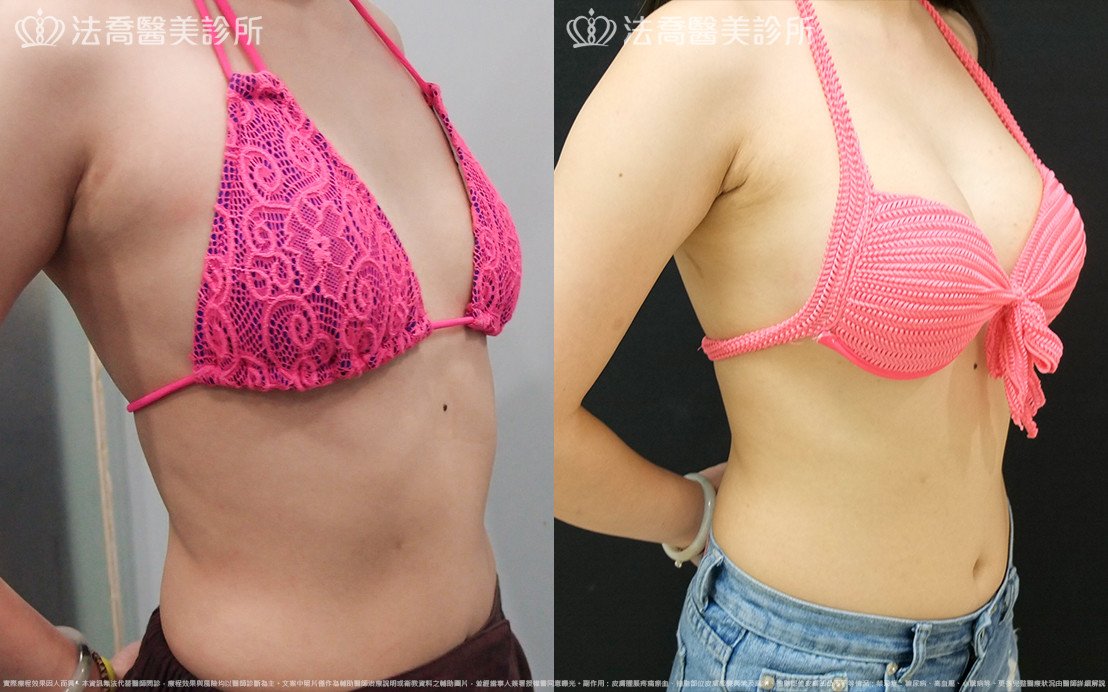 法喬醫美診所,邱浚彥,水滴果凍隆乳