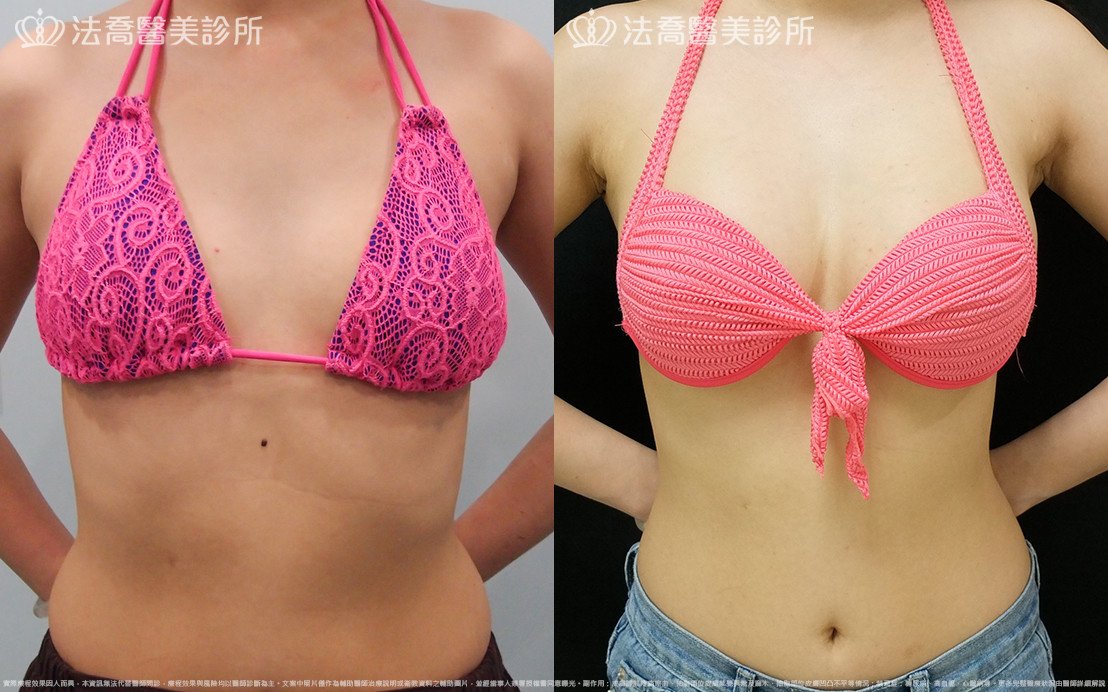 法喬醫美診所,邱浚彥,水滴果凍隆乳