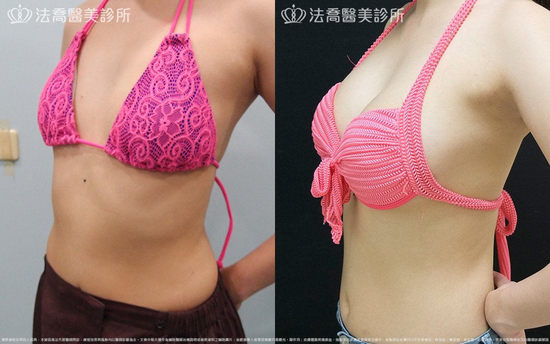 法喬醫美診所,邱浚彥,水滴果凍隆乳