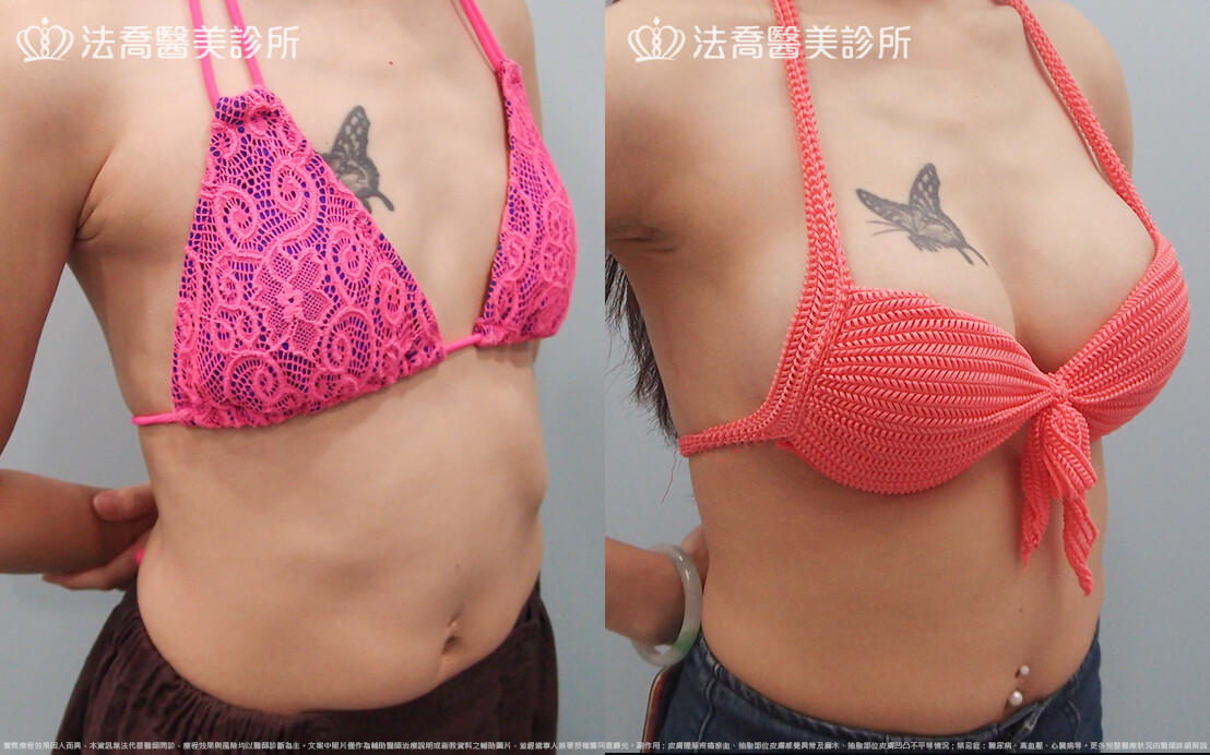 法喬醫美診所,邱浚彥,水滴果凍隆乳