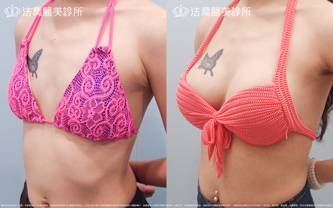 法喬醫美診所,邱浚彥,水滴果凍隆乳