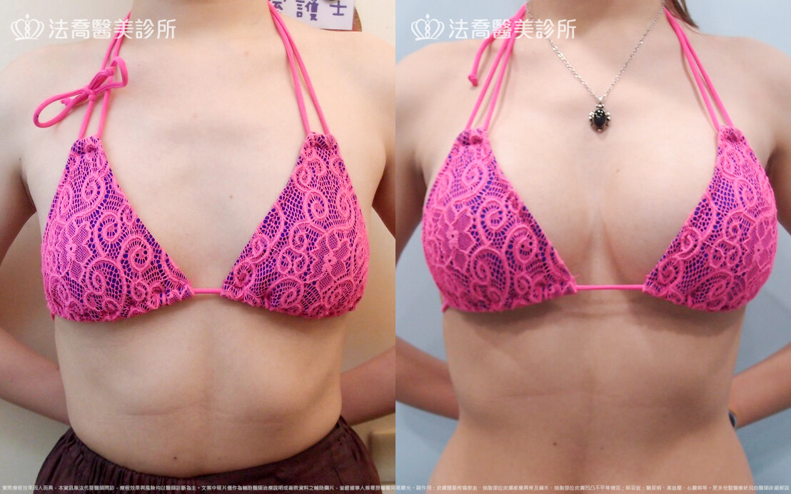 法喬醫美診所,邱浚彥,水滴果凍隆乳