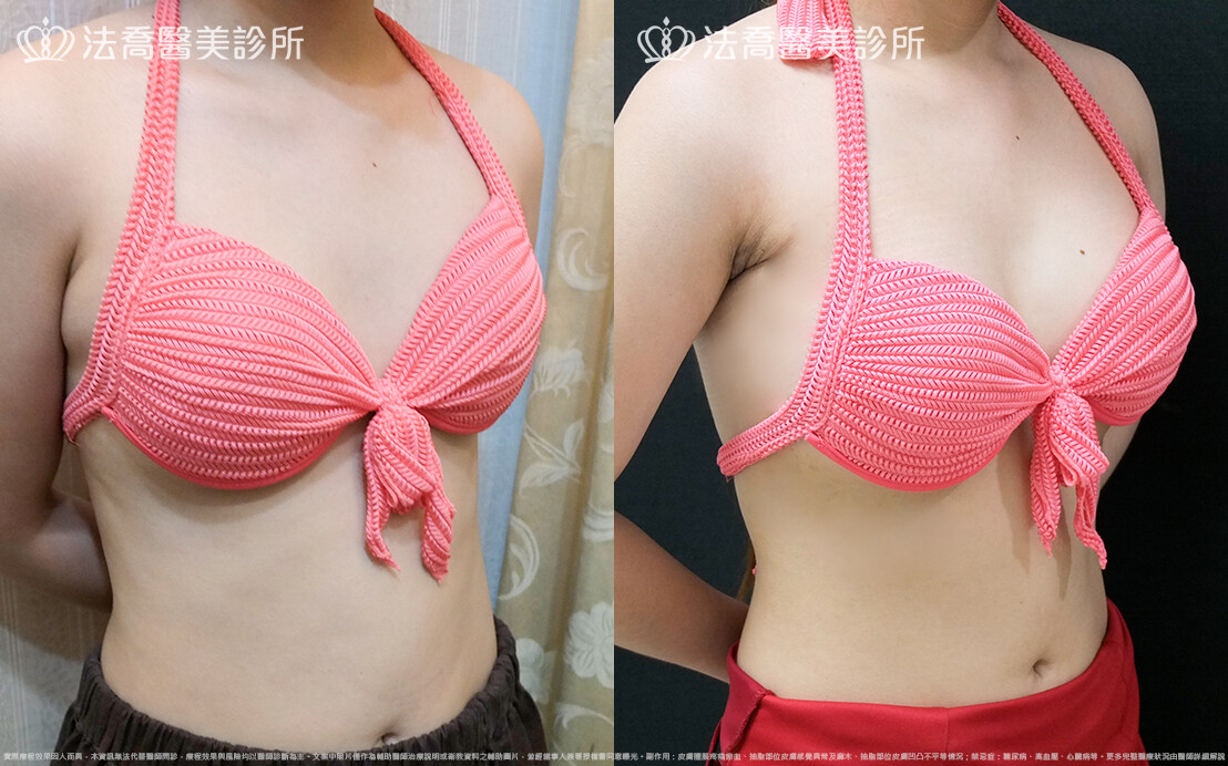 法喬醫美診所,邱浚彥,水滴果凍隆乳