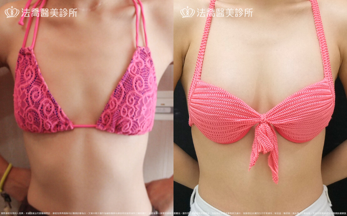 法喬醫美診所,邱浚彥,水滴果凍隆乳