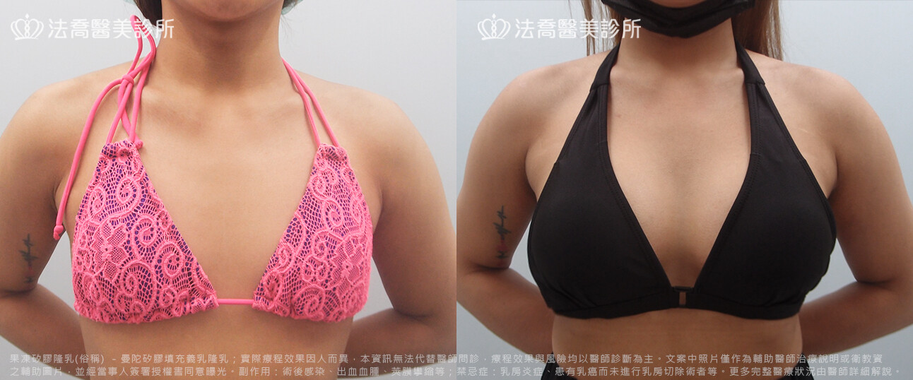 法喬醫美診所,邱浚彥,水滴果凍隆乳