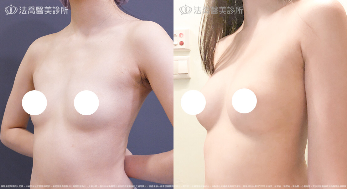 豐胸
