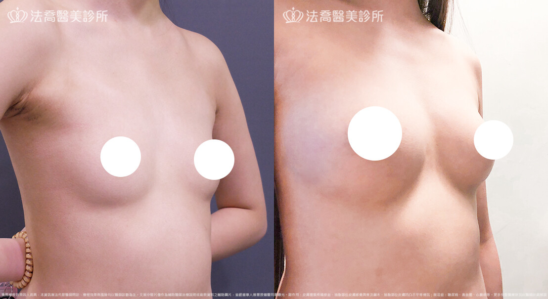 豐胸