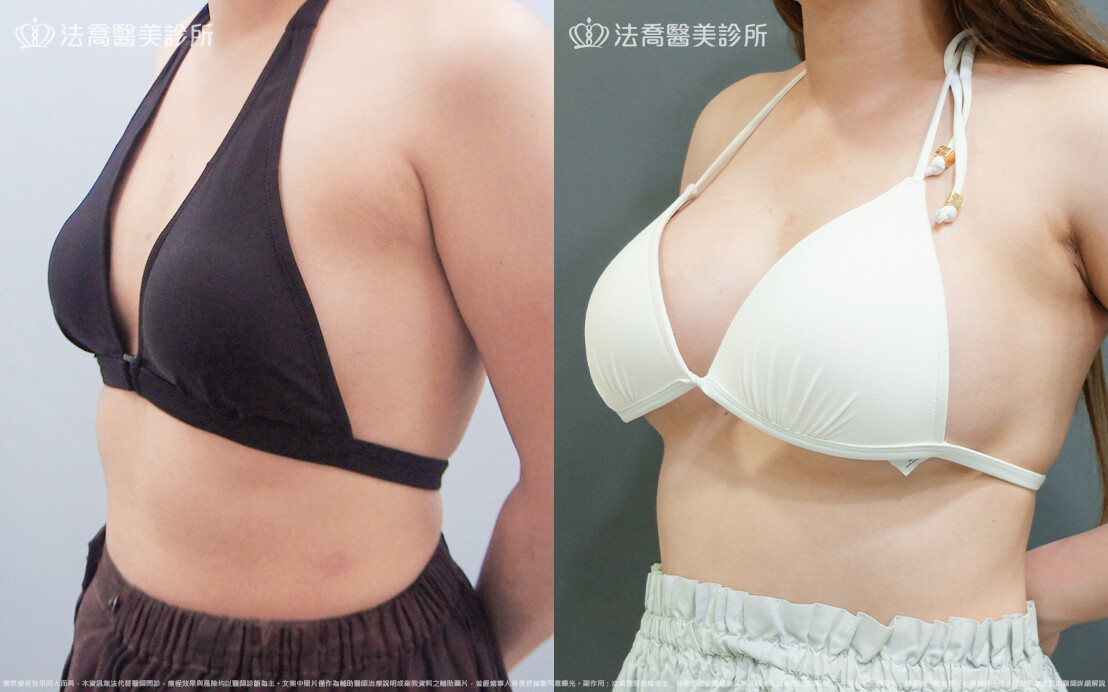 法喬醫美診所,邱浚彥,魔滴隆乳