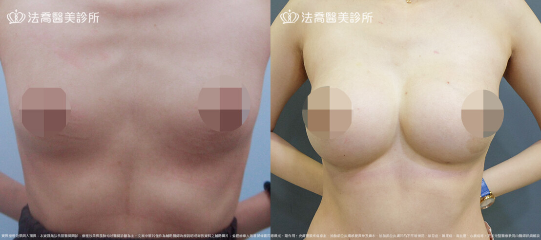 法喬醫美診所,邱浚彥,魔滴隆乳