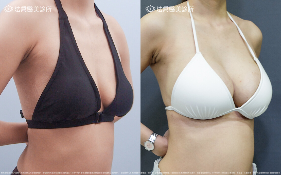 法喬醫美診所,邱浚彥,魔滴隆乳