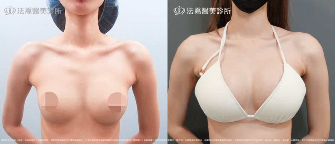 法喬醫美診所,邱浚彥,魔滴隆乳