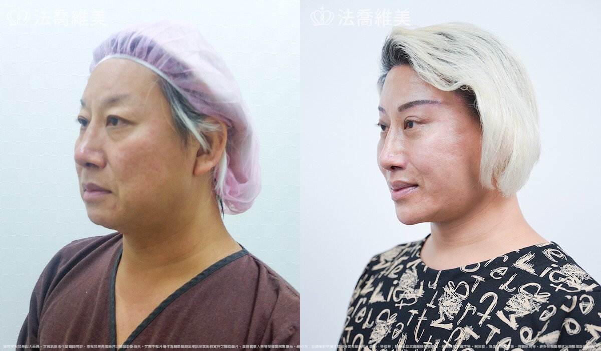 豐唇,法喬醫美診所,邱浚彥