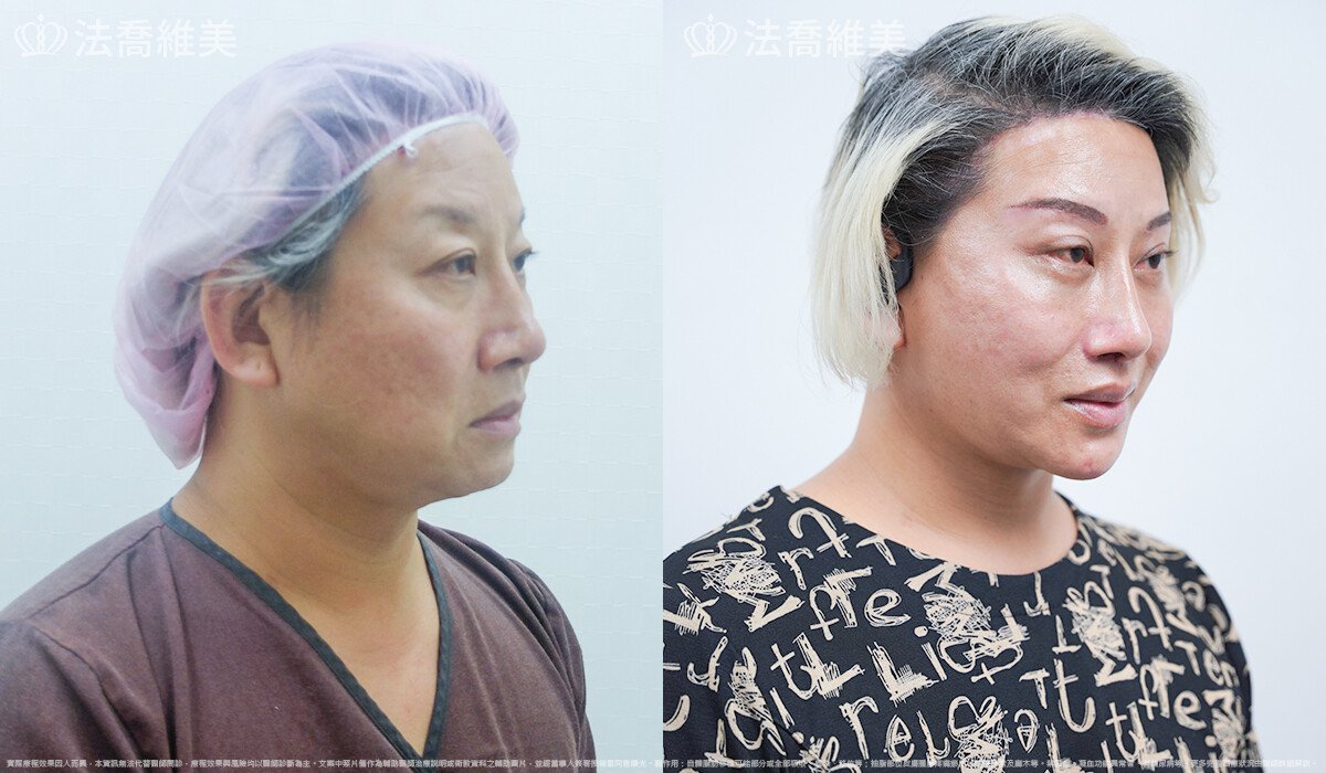 豐唇 ,法喬醫美診所,邱浚彥