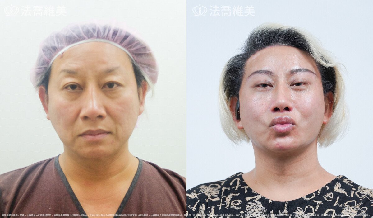 豐唇,法喬醫美診所,邱浚彥