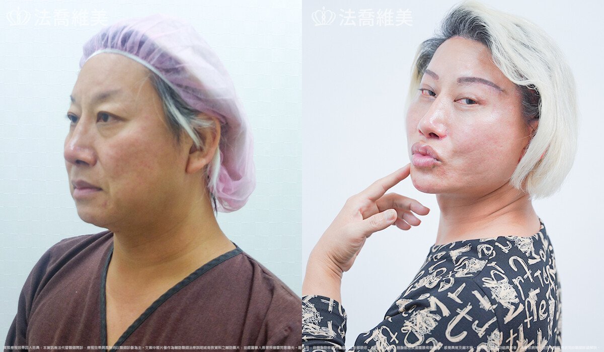 豐唇,法喬醫美診所,邱浚彥