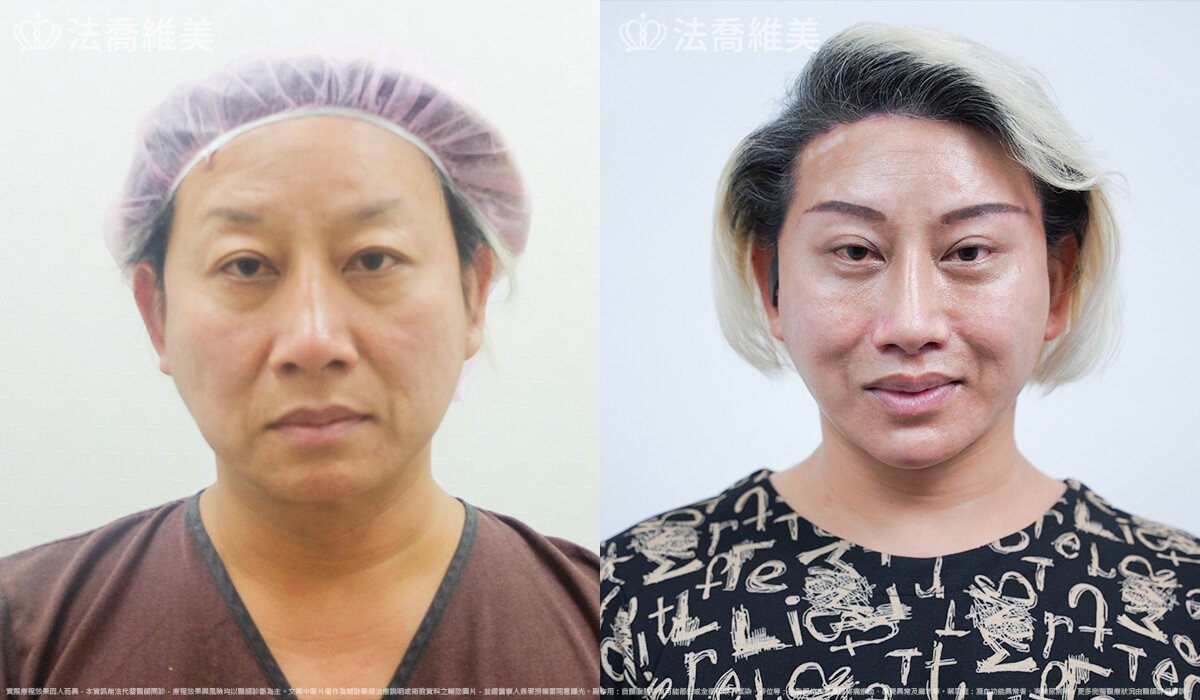 豐唇,法喬醫美診所,邱浚彥