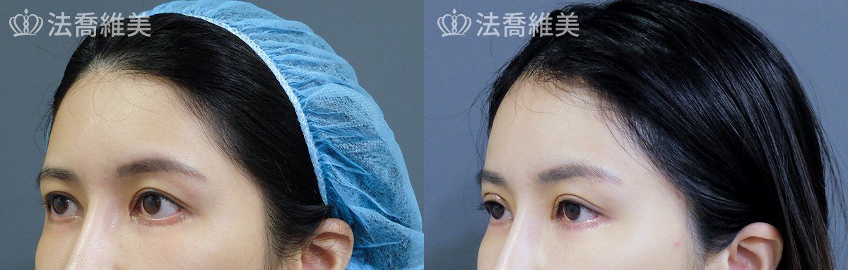 內視鏡前額五爪拉皮