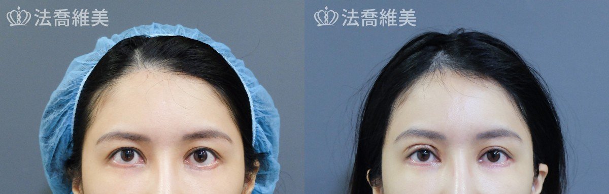 拉皮