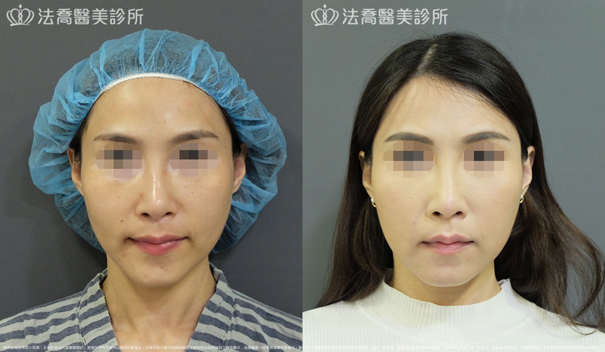 法喬醫美診所,邱浚彥,自體豐全臉