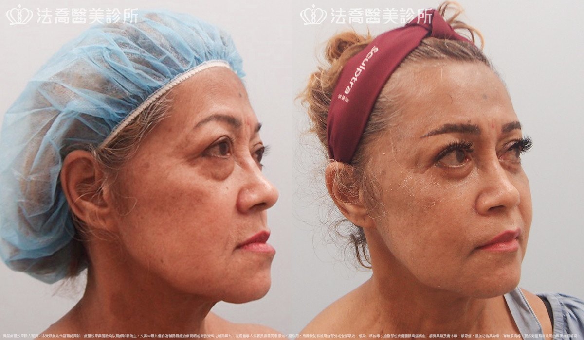 法喬醫美診所,邱浚彥,自體豐全臉