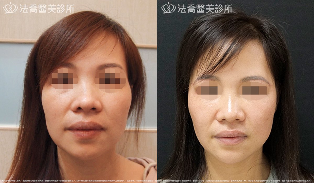 法喬醫美診所,邱浚彥,自體豐全臉