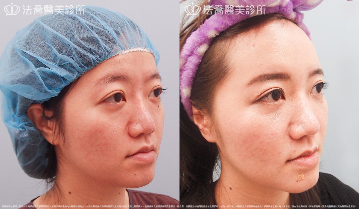 法喬醫美診所,邱浚彥,自體豐全臉