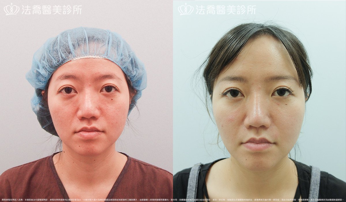 法喬醫美診所,邱浚彥,自體豐全臉