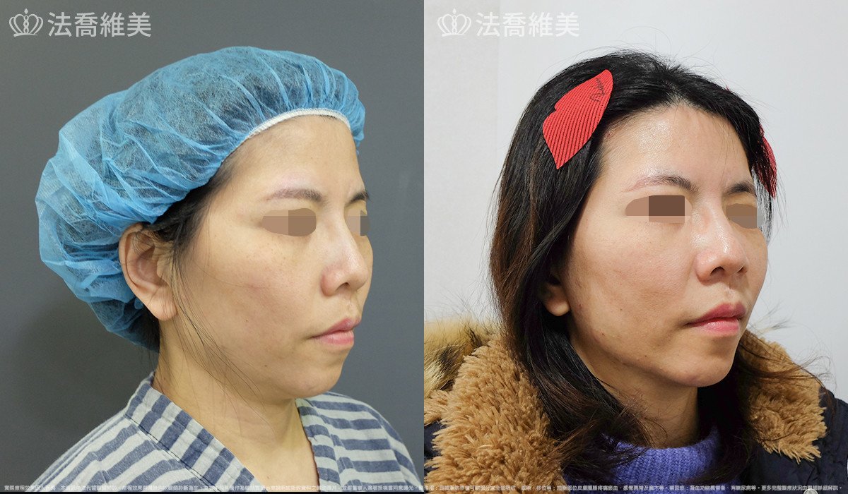 法喬醫美診所,邱浚彥,自體豐全臉