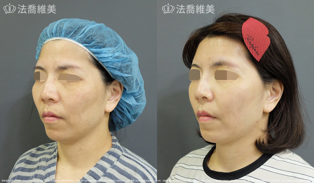 法喬醫美診所,邱浚彥,自體豐全臉