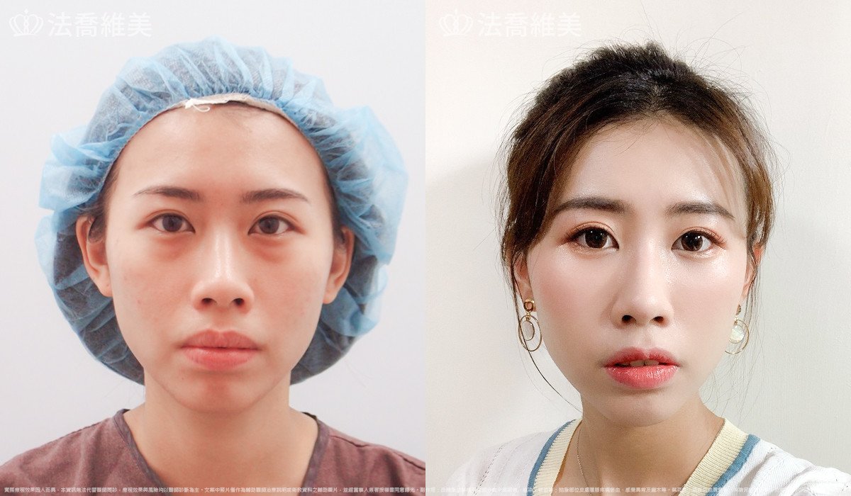 法喬醫美診所,邱浚彥,自體豐全臉