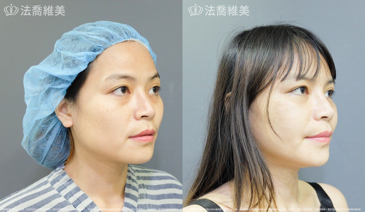 法喬醫美診所,邱浚彥,自體豐全臉