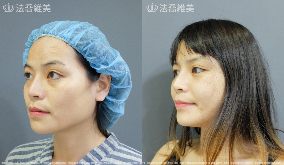 法喬醫美診所,邱浚彥,自體豐全臉