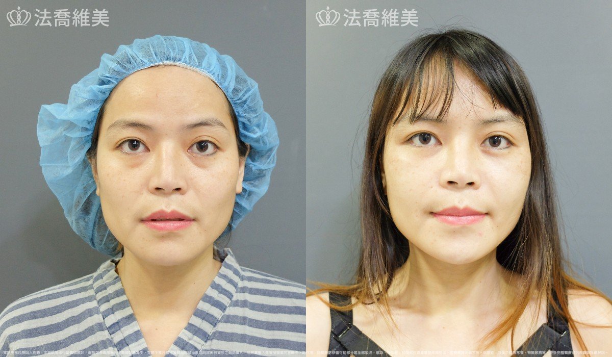 法喬醫美診所,邱浚彥,自體豐全臉