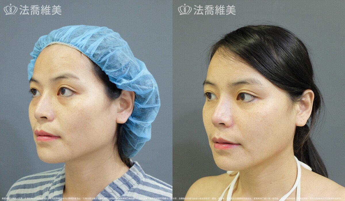 法喬醫美診所,邱浚彥,自體豐全臉