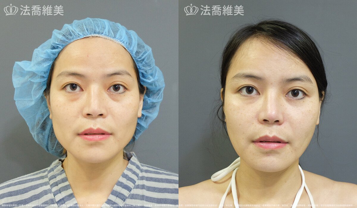 法喬醫美診所,邱浚彥,自體豐全臉