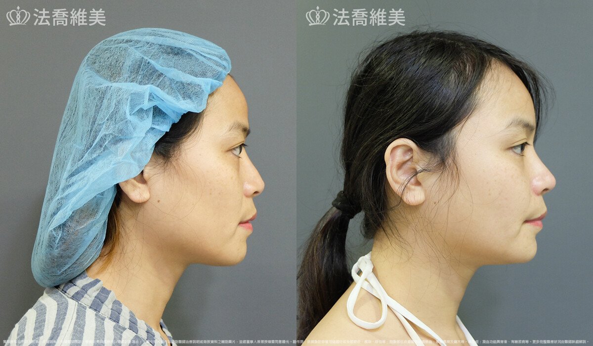 法喬醫美診所,邱浚彥,自體豐全臉