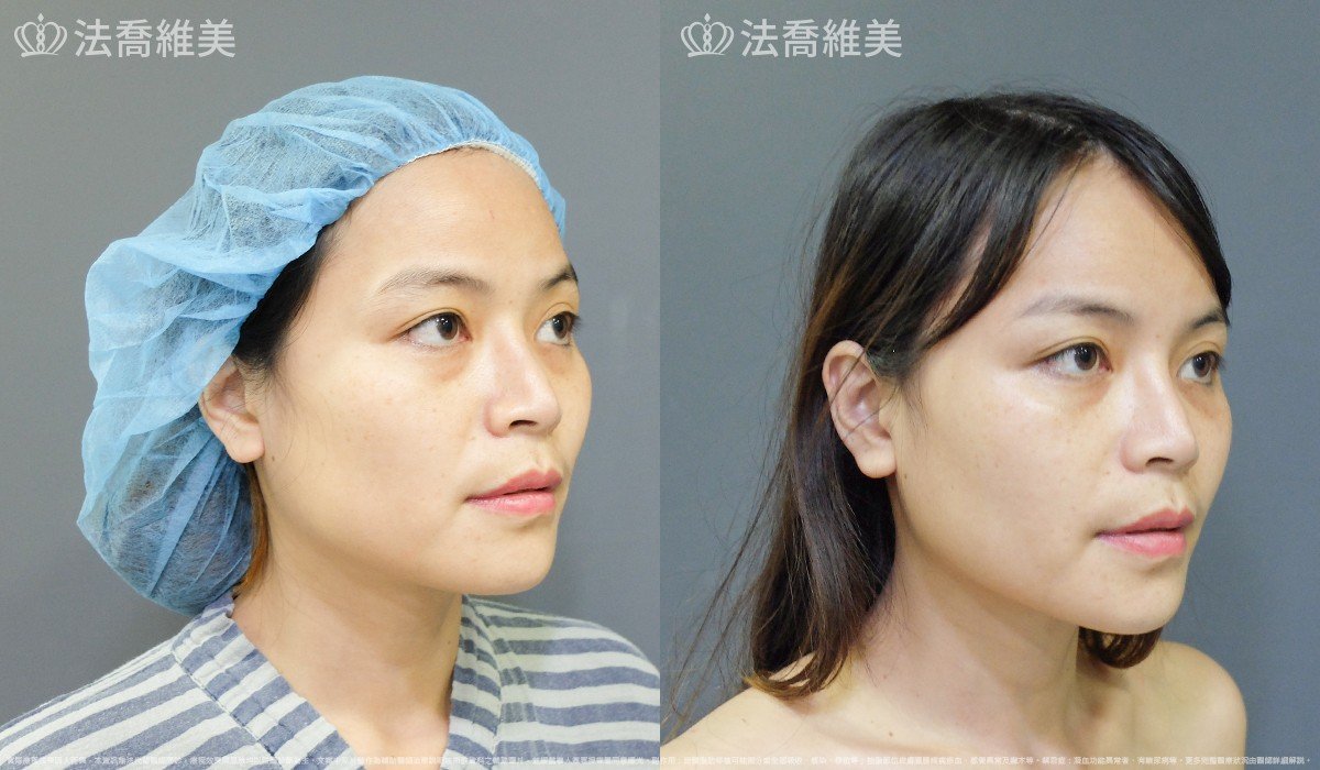 法喬醫美診所,邱浚彥,自體豐全臉