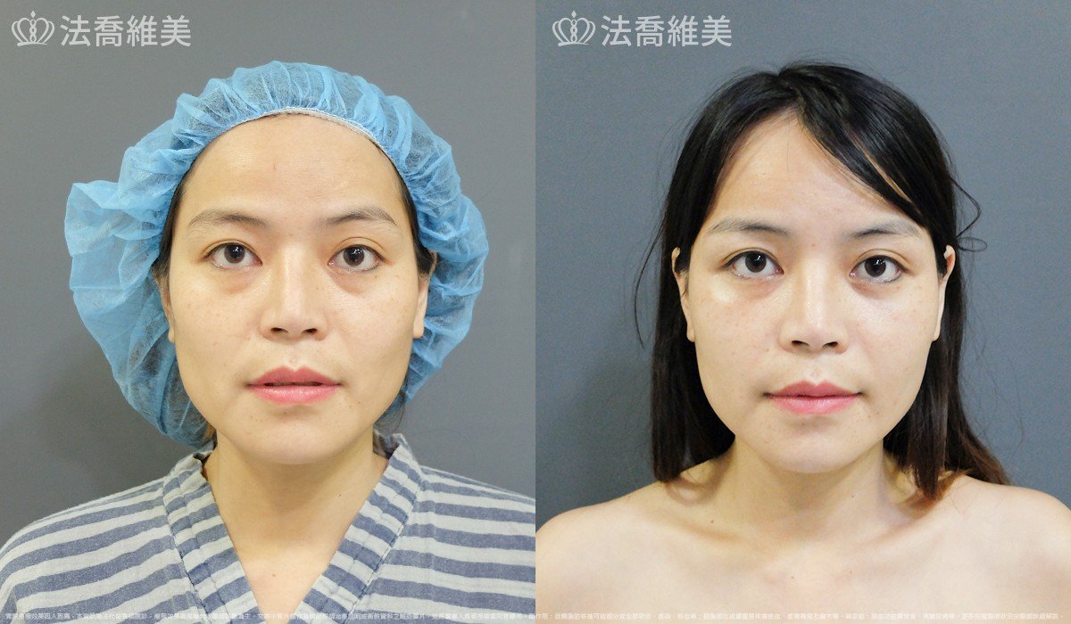 法喬醫美診所,邱浚彥,自體豐全臉