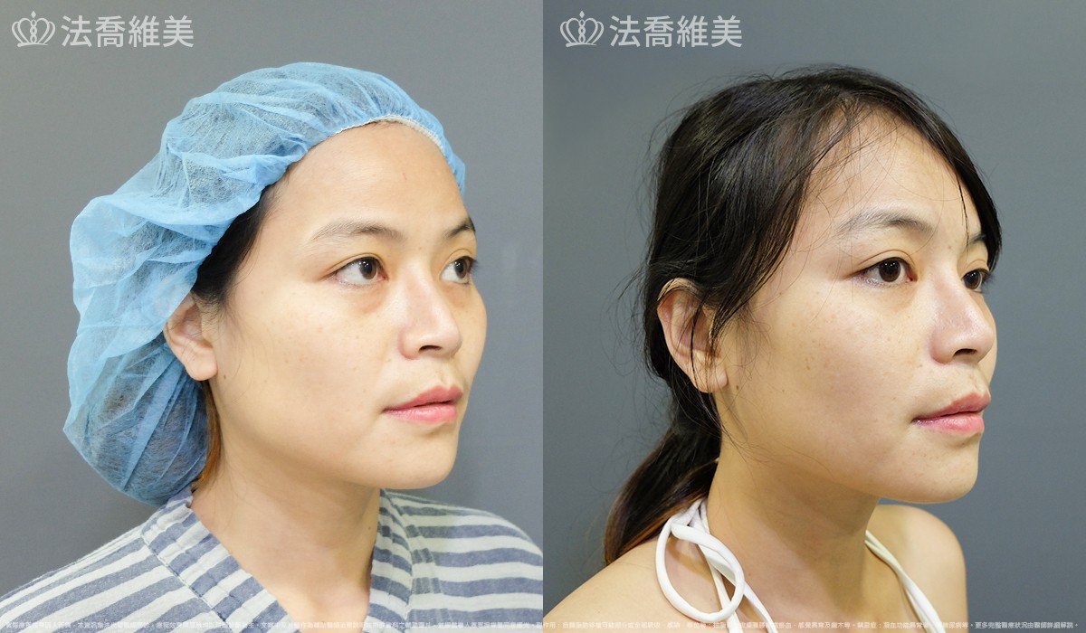 法喬醫美診所,邱浚彥,自體豐全臉