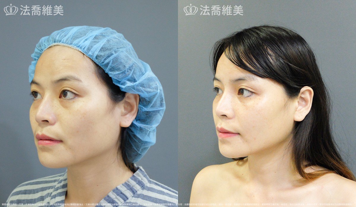 法喬醫美診所,邱浚彥,自體豐全臉