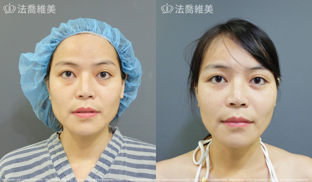 法喬醫美診所,邱浚彥,自體豐全臉