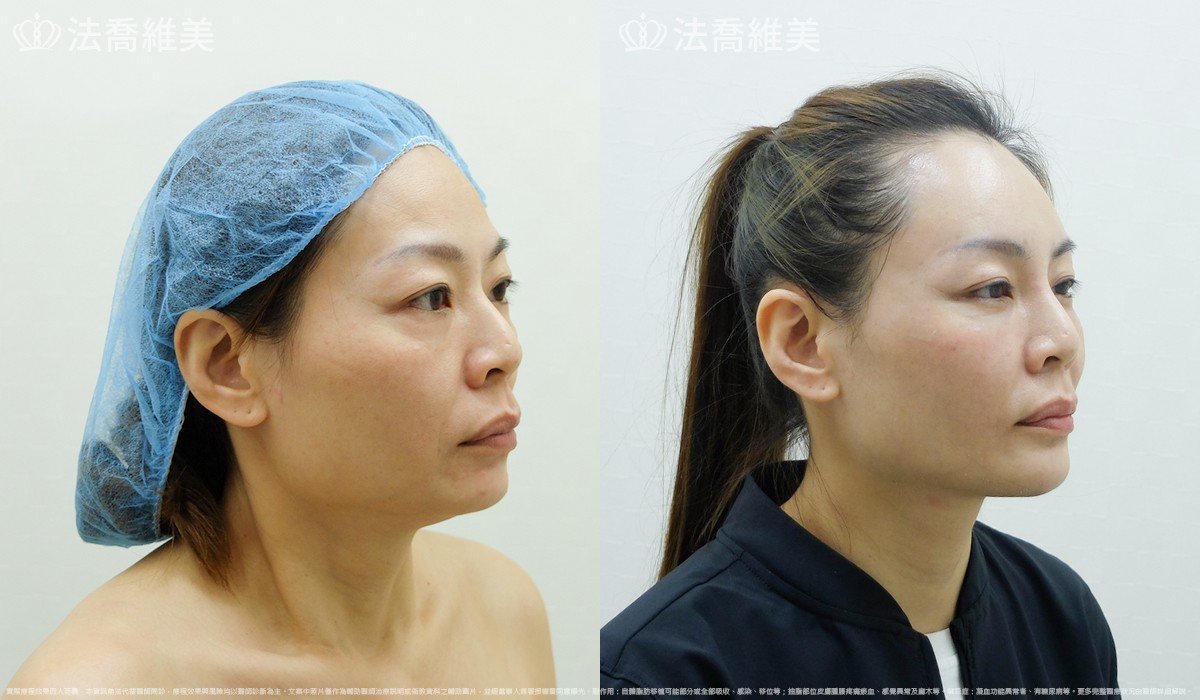 法喬醫美診所,邱浚彥,自體豐全臉