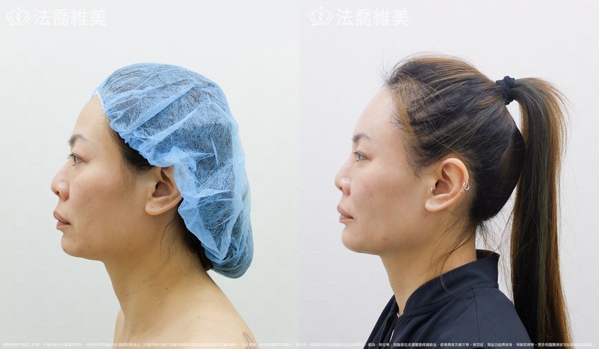 法喬醫美診所,邱浚彥,自體豐全臉