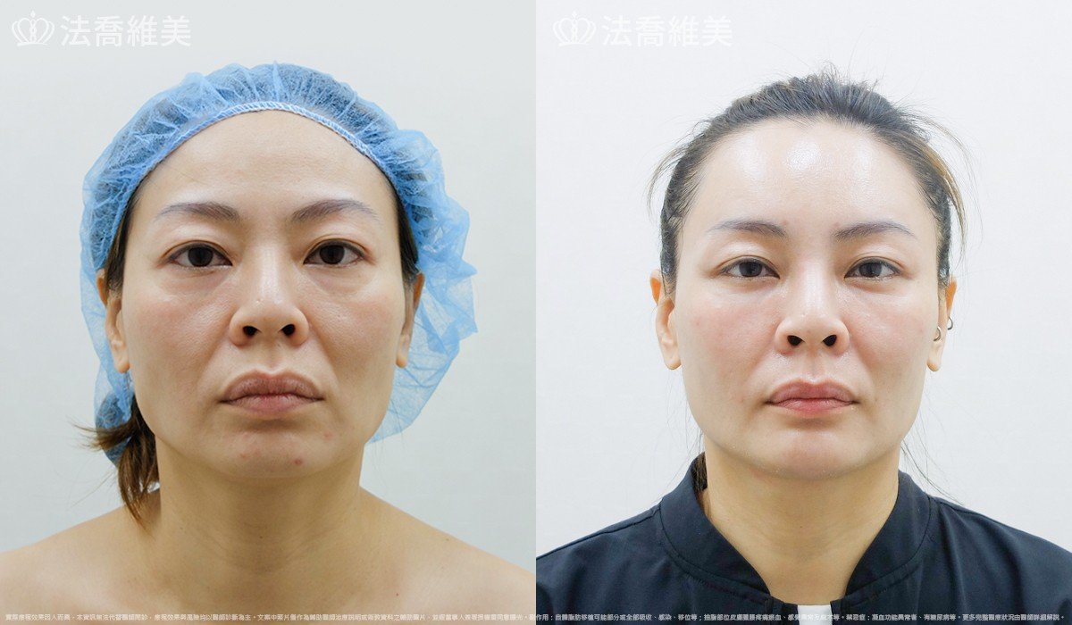 法喬醫美診所,邱浚彥,自體豐全臉