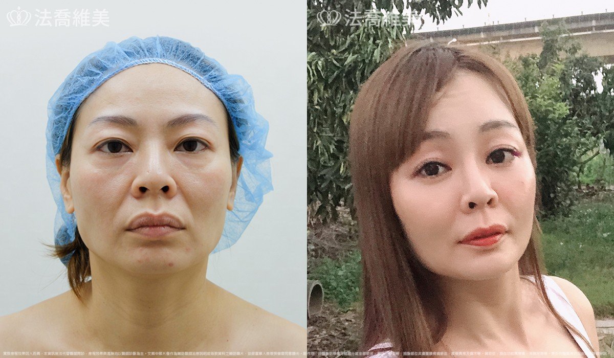 法喬醫美診所,邱浚彥,自體豐全臉