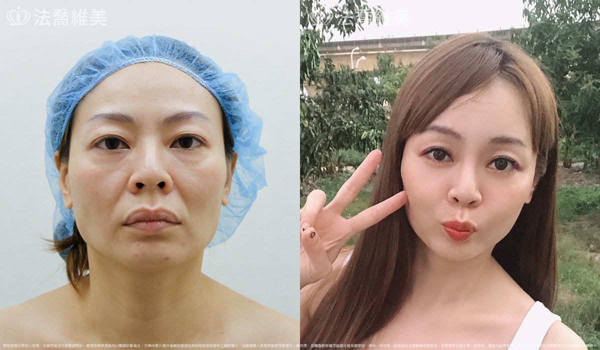 法喬醫美診所,邱浚彥,自體豐全臉