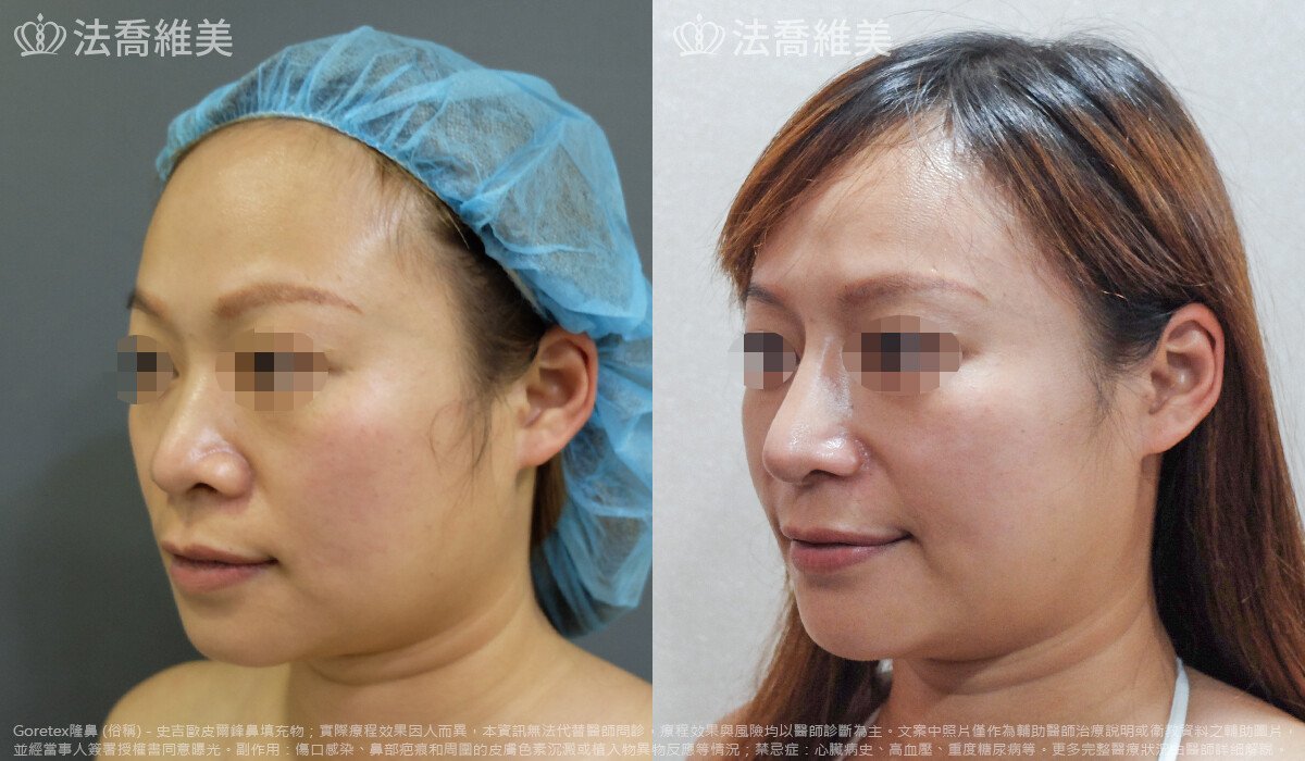 法喬醫美診所,邱浚彥,自體豐全臉