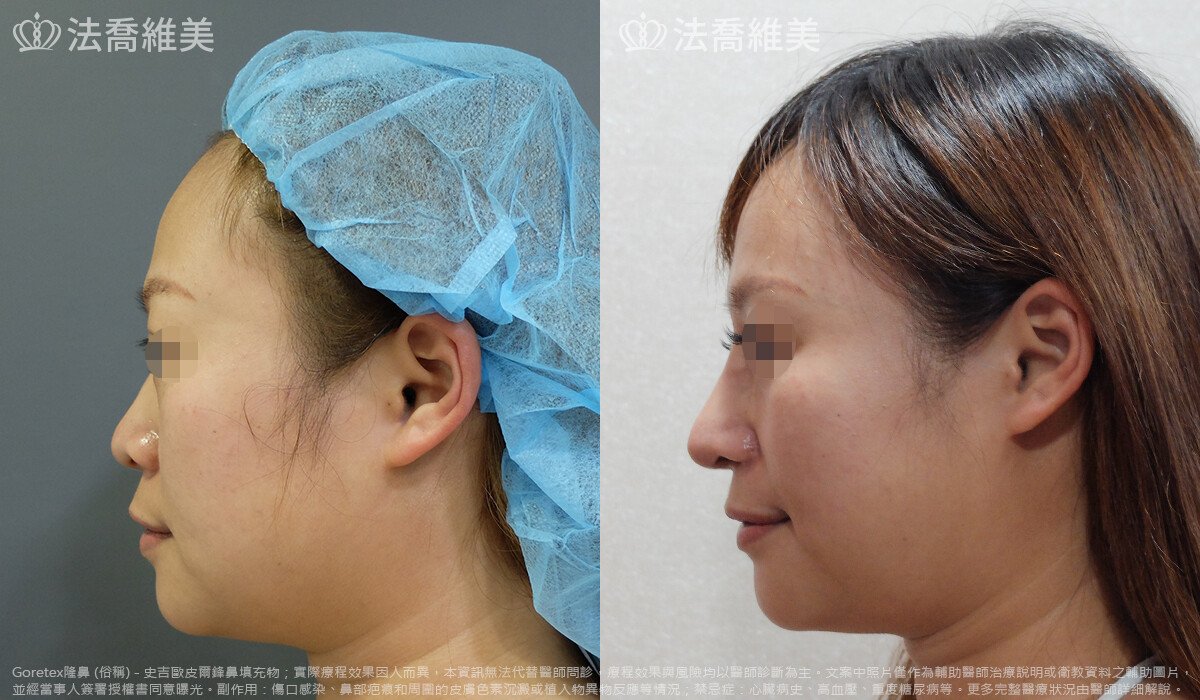 法喬醫美診所,邱浚彥,自體豐全臉