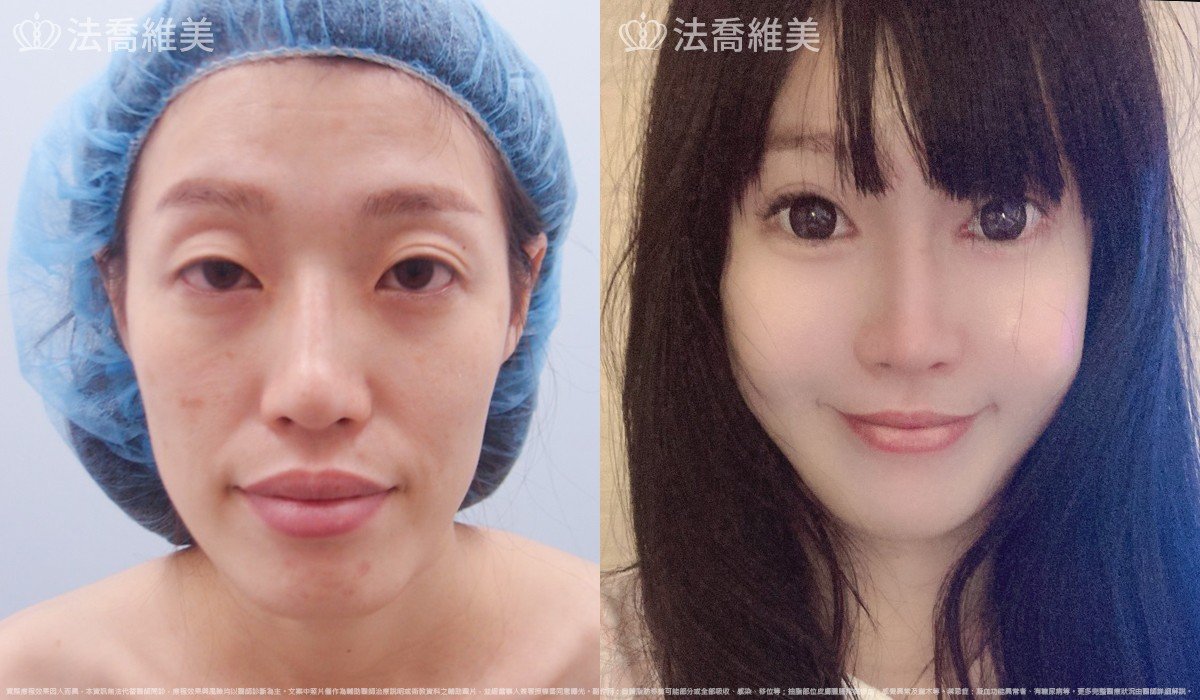 法喬醫美診所,邱浚彥,自體豐全臉