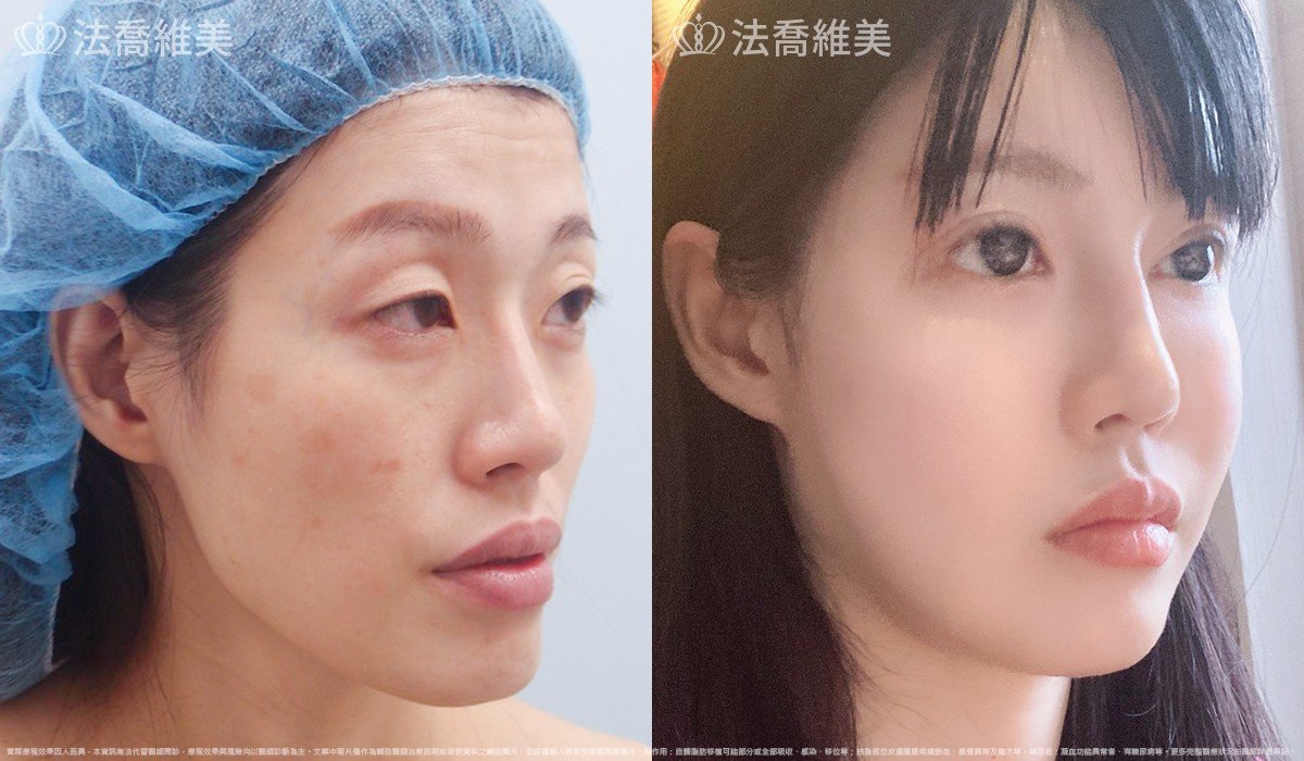 法喬醫美診所,邱浚彥,自體豐全臉